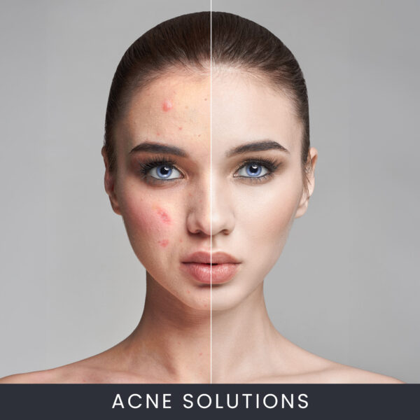 Acne Solutions Facial Course Online