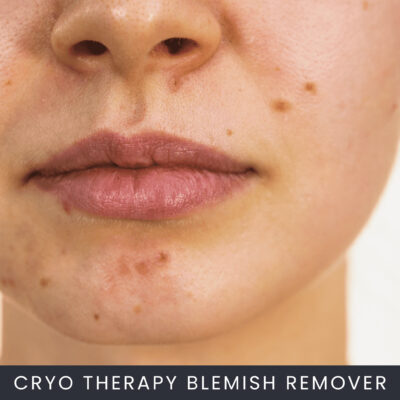 Cryo Therapy Blemish Removal Course Online