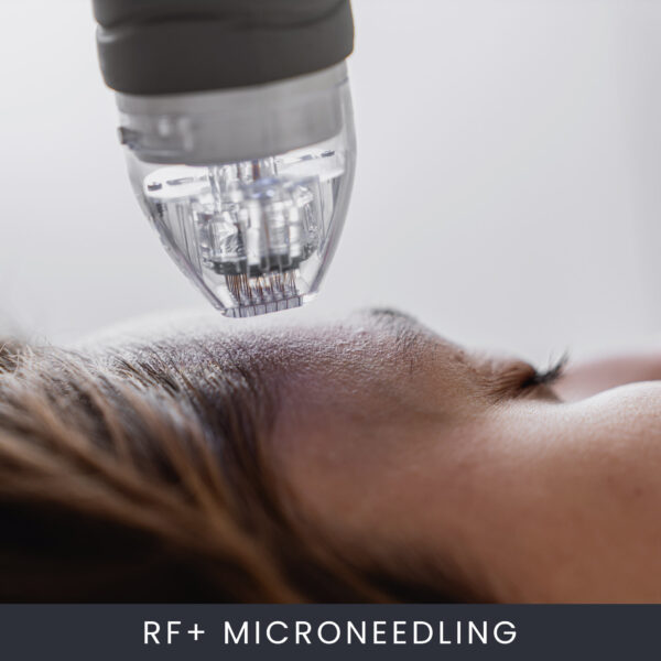 RF+ Microneedling