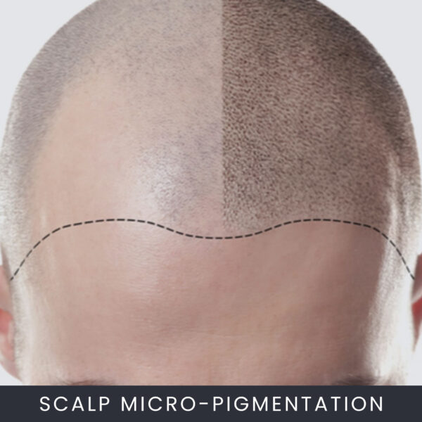 Scalp Micropigmentation Course Online Scalp Micropigmentation Course Online