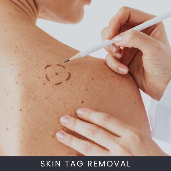 Skin Tag Removal Course Online