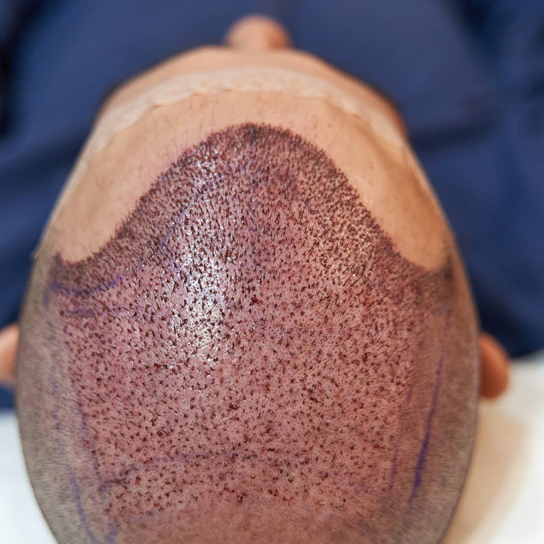 Scalp Micropigmentation Course Online The Online Beauty Courses US